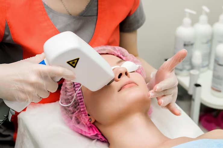 laser treatment for acne scars